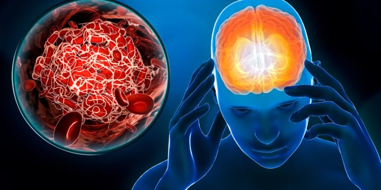 Illustration des Gehirns einer Person neben einer Illustration von Blutgerinnseln