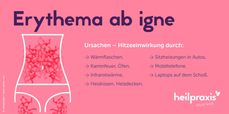 Übersichtsgrafik von Hitzequellen, die Erythema ab igne verursachen können 