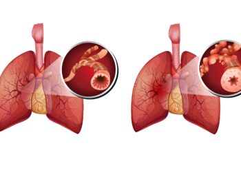 Vergleich: Lunge ohne COPD (links) und Lunge mit COPD (rechts)
