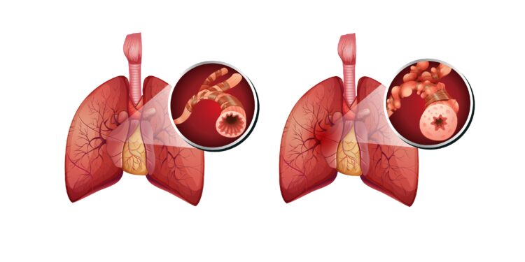 Vergleich: Lunge ohne COPD (links) und Lunge mit COPD (rechts)