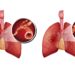 Vergleich: Lunge ohne COPD (links) und Lunge mit COPD (rechts)