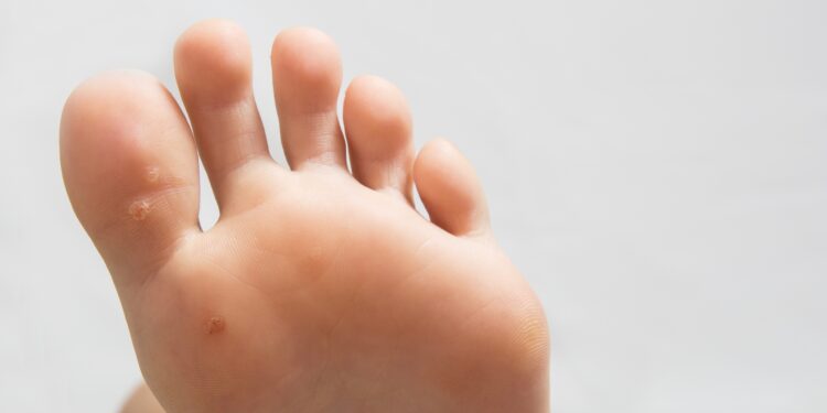 Die Zehen eines männlichen Fußes mit Warzen unter dem großen Zeh und auf dem Fußballen.