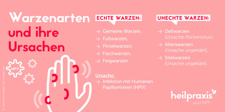 Übersicht der Warzenarten und ihrer Ursachen. Eine Auflistung und eine Grafik einer Hand mit Warzen.