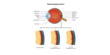 Darstellung eines Auges mit Makuladegeneration.