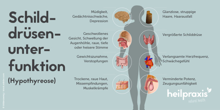 Übersicht über einige Symptome einer Schilddrüsenunterfunktion (Hypothyreose)