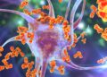 Grafische Darstellung einer Nervenzelle, die von körpereigenen Immunzellen angegriffen wird.
