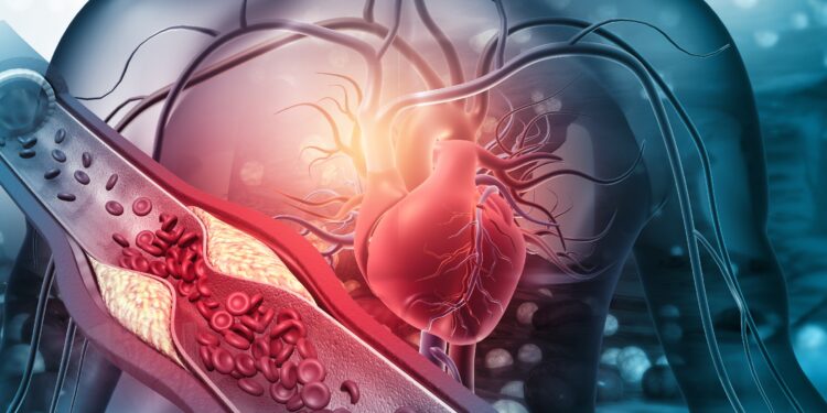 Grafische Darstellung eines Herzens und einer Arterie, die mit Plaques verstopft ist.