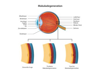 Schaubild zu der altersbedingten Augenerkrankung Makuladegeneration (AMD).