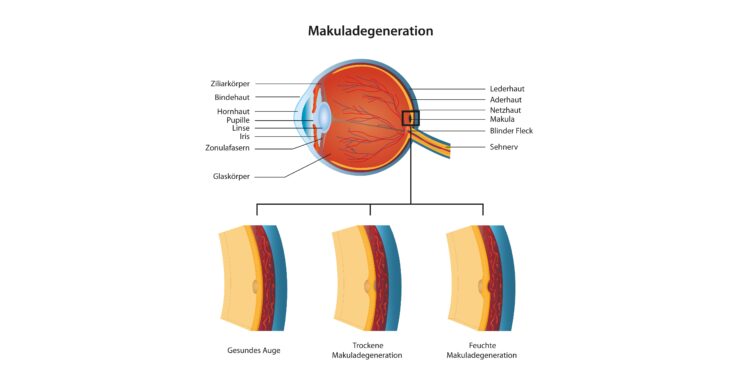 Schaubild zu der altersbedingten Augenerkrankung Makuladegeneration (AMD).