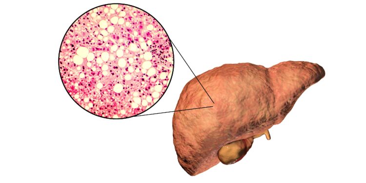 Grafische Darstellung einer Fettleber.
