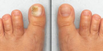 Zeh mit Nagelpilz vor und nach einer Behandlung