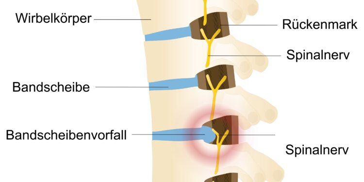 Grafische Darstellung eines Bandscheibenvorfalls