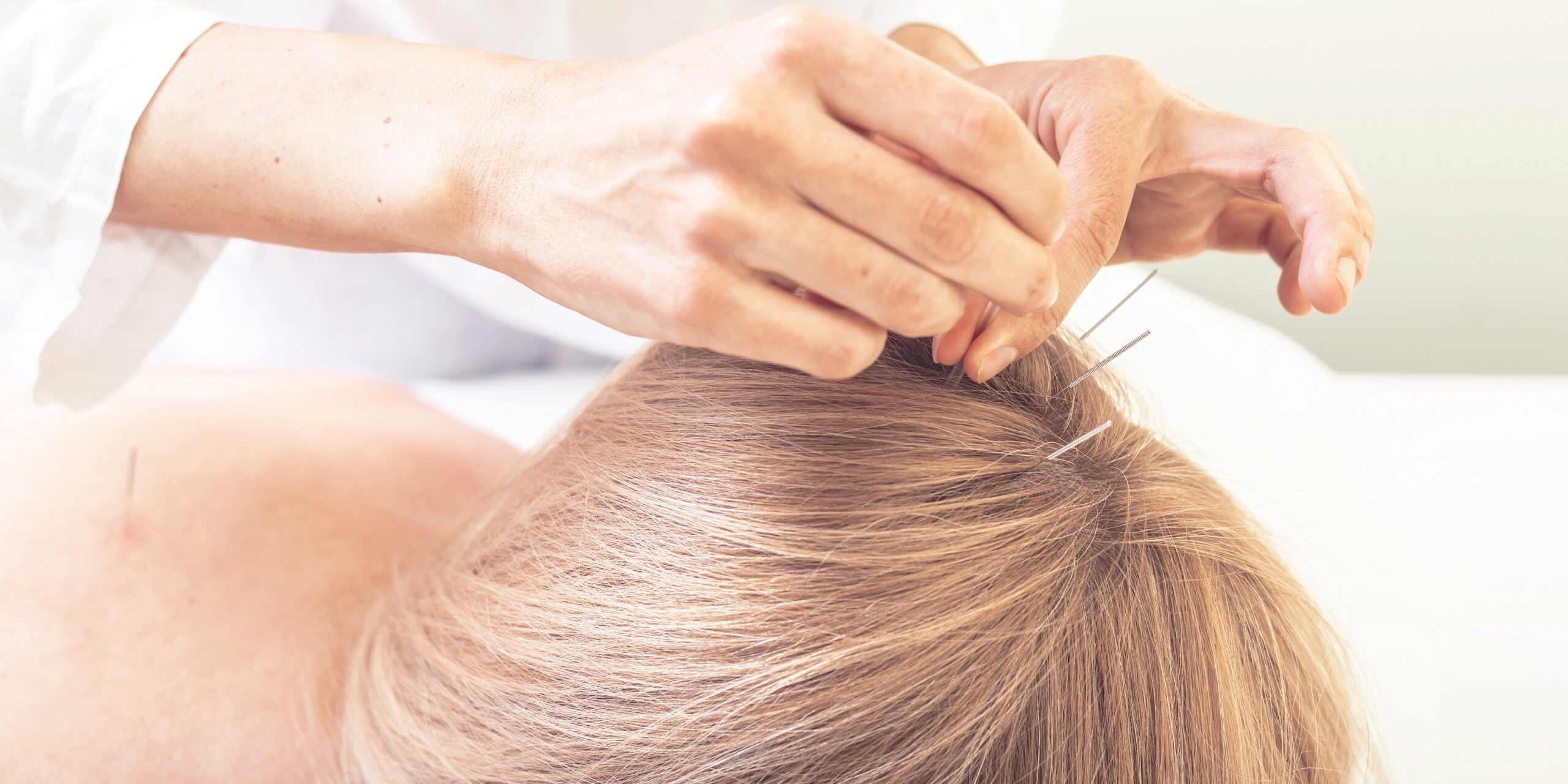 Schlaganfall-Akupunktur-kann-bei-Anschlusstherapie-helfen
