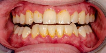 Zahnstein ist nicht nur optisch unschön, sondern bringt auch gesundheitliche Risiken mit sich, die unbedingt vermieden werden sollten. (Bild: Dirk/stock.adobe.com)