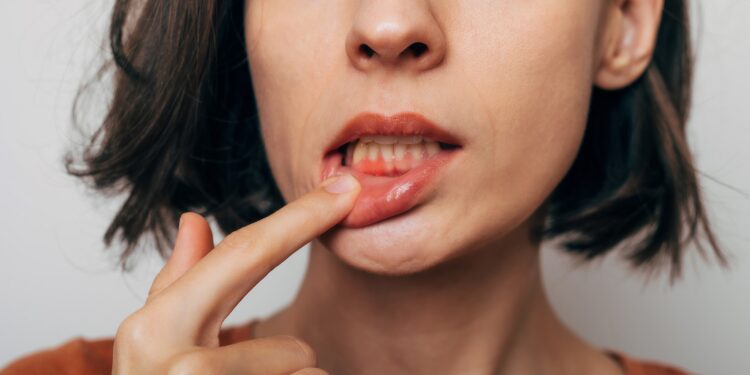 Frau zeigt auf ihr entzündetes Zahnfleisch im Mund.